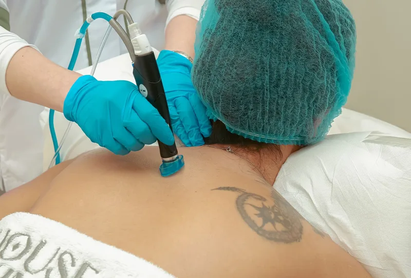 Key West Tattoo Removal in Key West