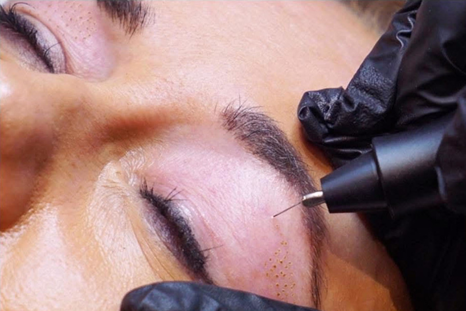 Platinum Plasma Pen Treatment