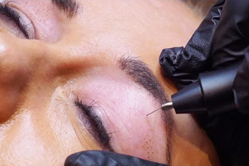 Platinum Plasma Pen Treatment